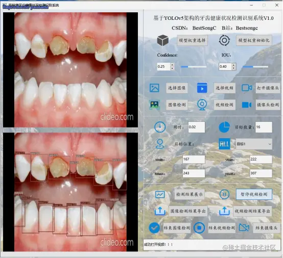 高精度牙齿健康状态检测识别系统2578.png